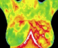 8 Matsu Skin Deep Thermal Imaging Fibrosystic Breast 1 200×165
