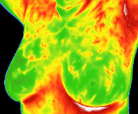 7 Matsu Skin Deep Thermal Imaging Fibrosystic Breast 3 200×165