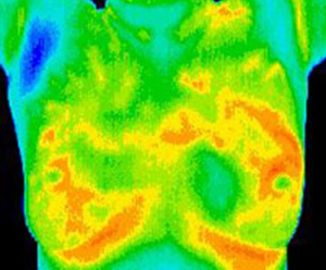 Matsu Skin Deep Thermal Imaging Mastitis Scan 300×248
