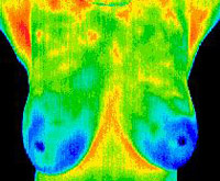 1 Matsu Skin Deep Thermal Imaging Normal Breast Scan 200×165