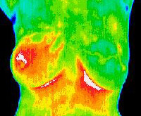 9 Matsu Skin Deep Thermal Imaging Inflammatory Carcinoma Scan 200×165